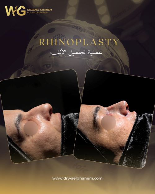 افضل دكتور تجميل الانف